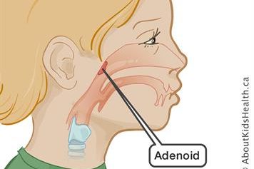 Adenoids_MED_ILL_EN