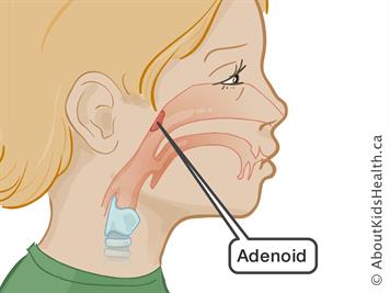Adenoids_MED_ILL_EN