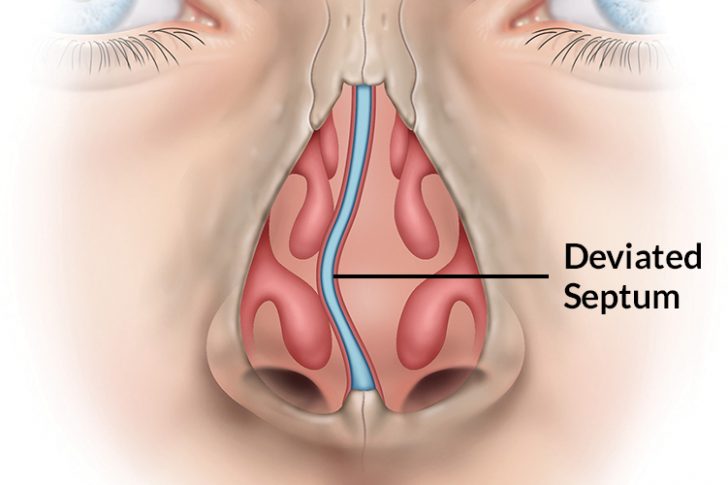 Deviated-Septum-pic