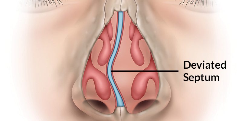 Deviated-Septum-pic