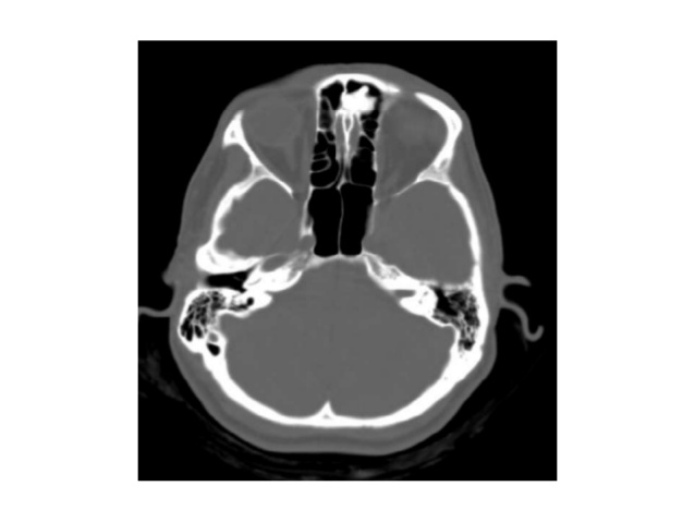 osteomat-e-panderlikuara-te-sinusit-frontal-4-638